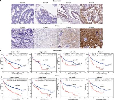 Expression of Cartilage Oligomeric Matrix Protein in colorectal cancer is an adverse prognostic factor and correlates negatively with infiltrating immune cells and PD-L1 expression